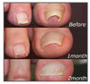 EasyPatches Correction patches for beautiful and healthy nails - Givemethisnow