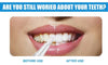 Sparkle Tooth Teeth Whitening Pen - Givemethisnow