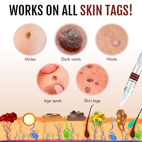 WipeOff™ Tags & Moles Remover - Givemethisnow