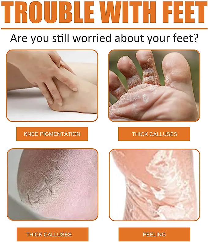 GFOUK™ Foot Callus Removal Spray - Givemethisnow