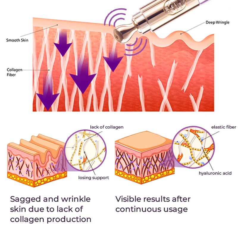 GFOUK™️ Milk Spots Therapy Electric Serum Pen - Givemethisnow