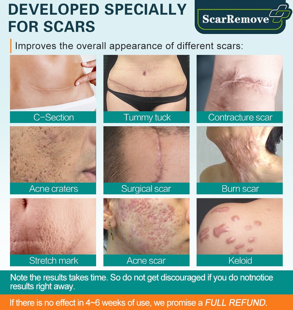 🔥🔥🔥ScarRemove™ Advanced Scar Spray For All Types of Scars - Especially Acne Scars, Surgical Scars and Stretch Marks - Givemethisnow