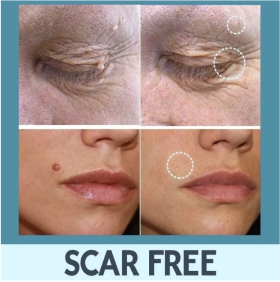 Skin Tag Remover Patches - Givemethisnow