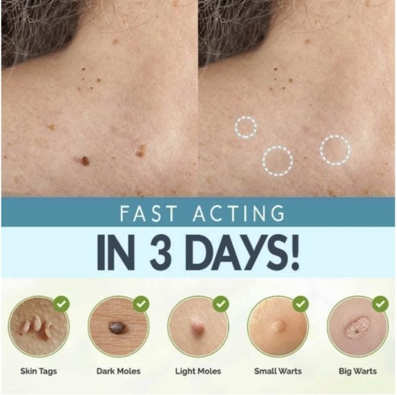 Skin Tag Remover Patches - Givemethisnow