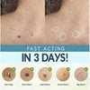 Skin Tag Remover Patches - Givemethisnow