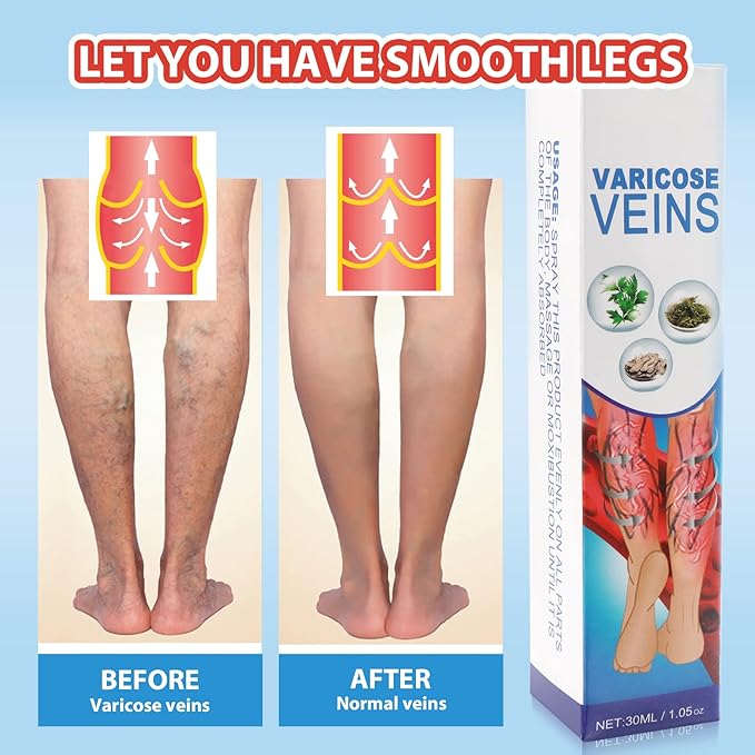 South Moon Varicose Vein Spray - Givemethisnow